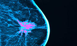 mammogram image
